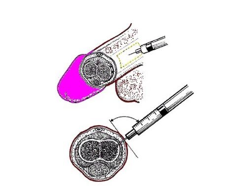 vaseliini pumpamine peenisesse suurendamise viisiks